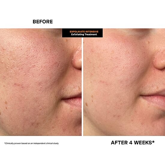 Kate Somerville Exfolikate® Intensive Exfoliating Treatment 2 Fl. Oz.