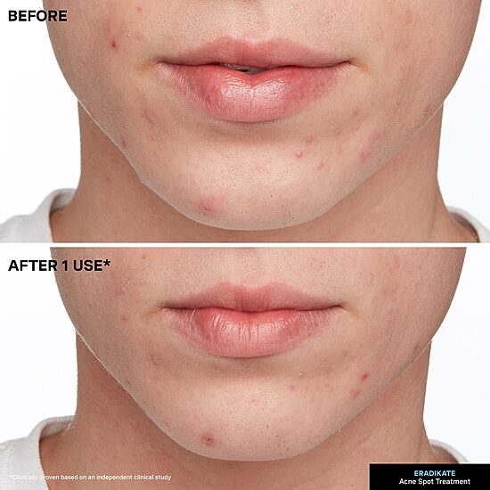 Kate Somerville Eradikate® 10% Sulfur Acne Treatment