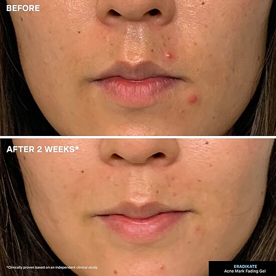 Kate Somerville Eradikate® Acne Mark Fading Gel