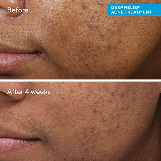 Murad Deep Relief Acne Treatment