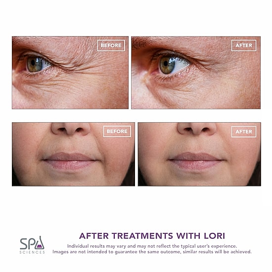 Spa Sciences Lori- Facial Lifting & Serum Infusion Wand With Cold & Heat Therapy For Eyes & Lips