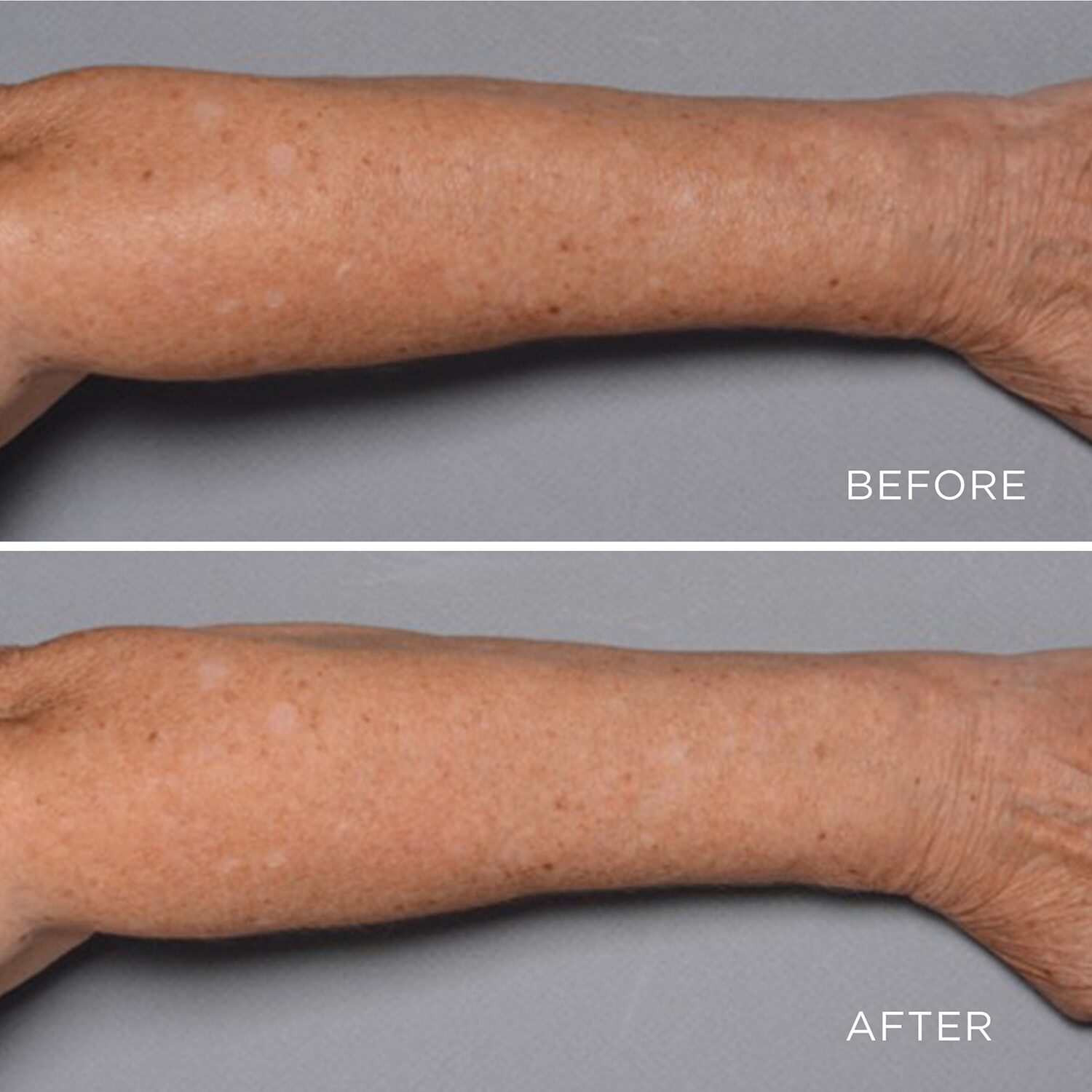 Perricone MD Cold Plasma Plus+ Fragile Skin Therapy (Tube)