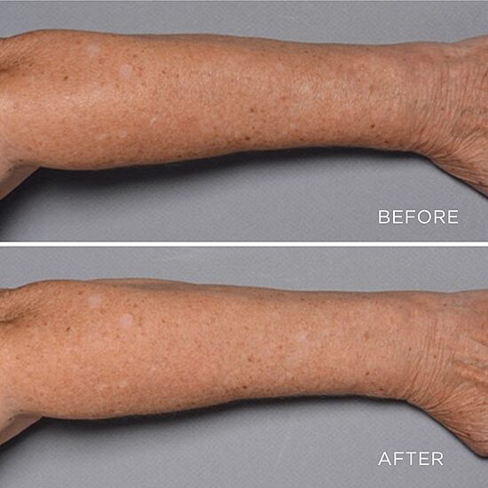 Perricone MD Cold Plasma Plus+ Fragile Skin Therapy (Tube)