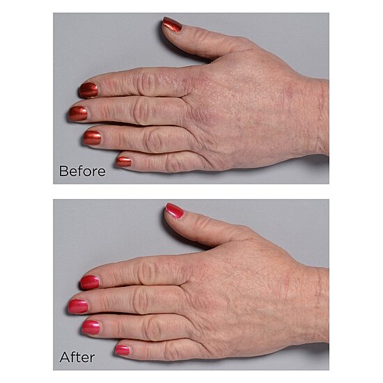 Perricone MD Cold Plasma Plus+ Hand Therapy
