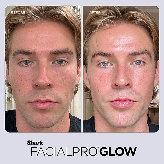 Shark BEAUTY™ Facialpro™ Glow At Home Facial System